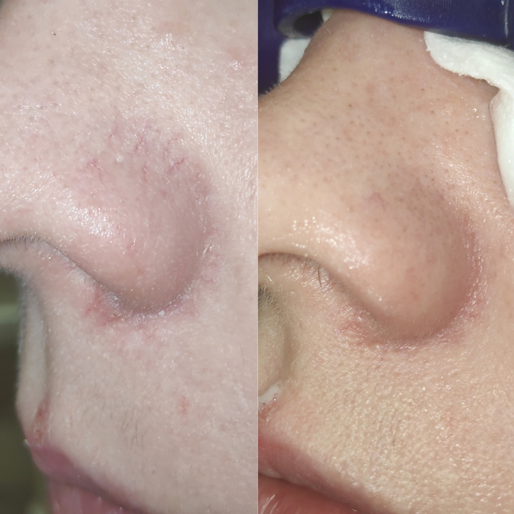 Терапия сосудов на Capello Elight (4) (1).jpg